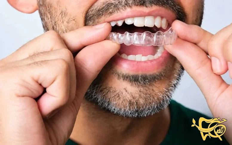 Invisible Orthodontics: Advantages and