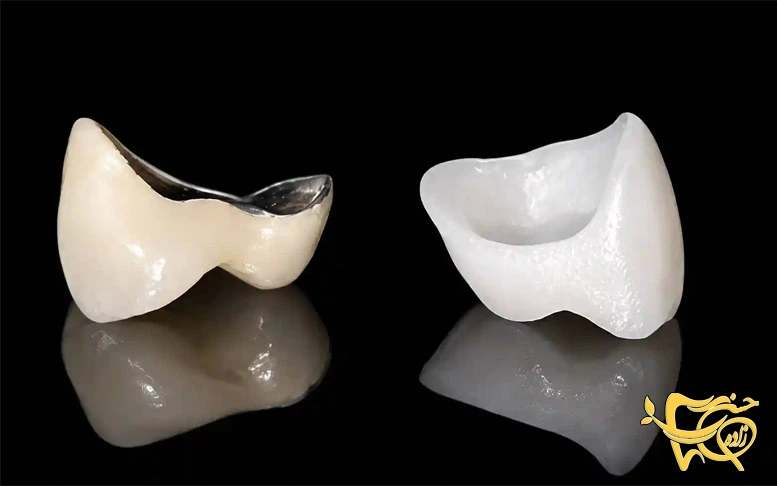 Zirconia And PFM Crown Comparison