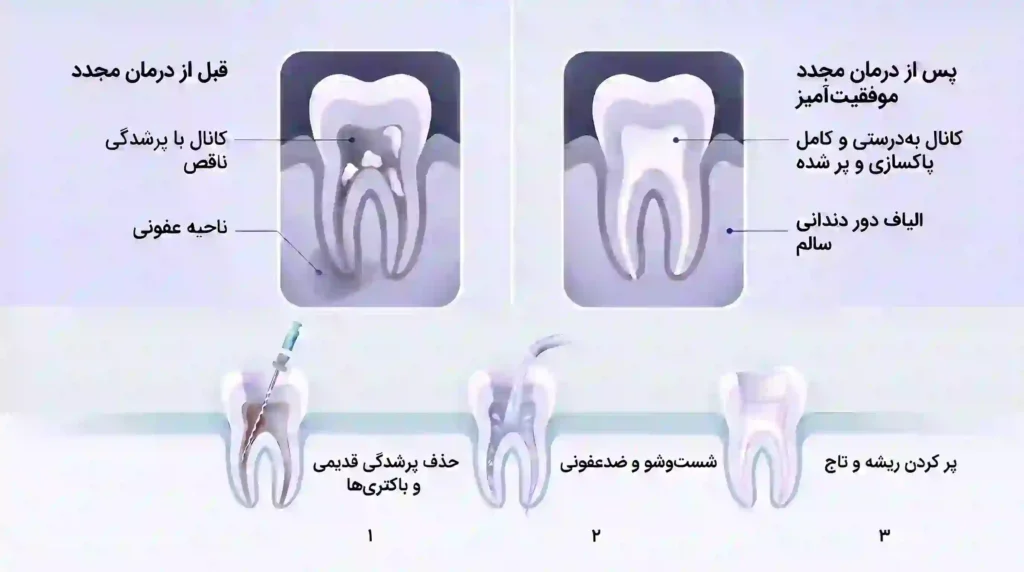 مقایسه قبل و بعد از درمان مجدد ریشه